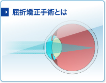 屈折矯正手術とは