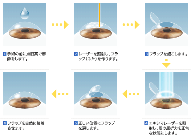 1.手術の前に点眼薬で麻酔をします。 2.レーザーを照射し、フラップ（ふた）を作ります。 3.フラップを起こします。 4.エキシマレーザーを照射し、眼の屈折力を正常な状態にします。 5.正しい位置にフラップを戻します。 6.フラップを自然に接着させます。