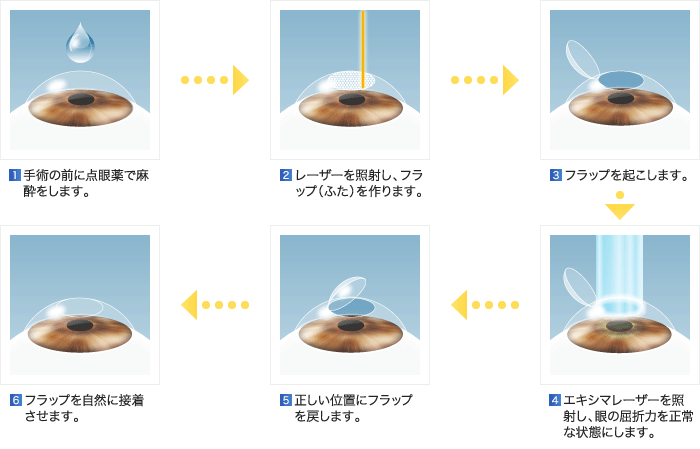 レーシック 手術 値段