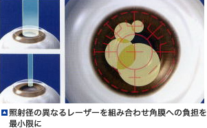 レーザー照射図